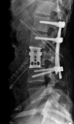 Fracture lombaire opérée par double abord