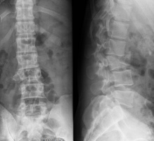 Fracture du rachis lombaire