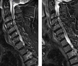 Myélopathie cervicale