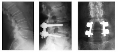 spondylolisthesis dégénratif