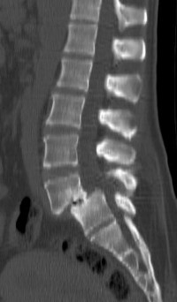 Spondylolisthesis Lombaire