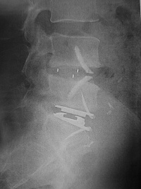 montage mixte : prothèse + arthrodèse