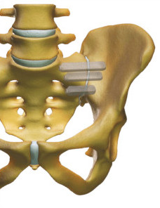 arthrodèse sacro-iliaque