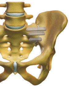 Schema postoperatoire sacro-iliaque